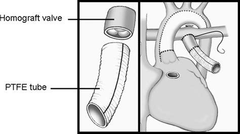 pulmonary homograft conduit performance